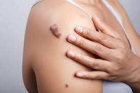 कीलॉईड (Keloid)